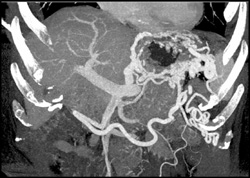 Splenic Vein Occlusion With Varices - CTisus CT Scan