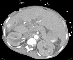 Hepatoma - CTisus CT Scan