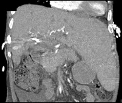 1 Cm Hepatocellular Carcinoma (HCC) - CTisus CT Scan