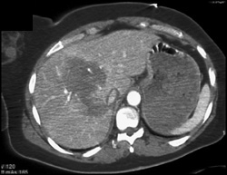 Acute Liver Laceration - CTisus CT Scan