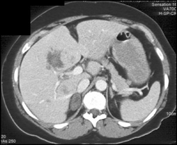 Intrahepatic Hematoma - CTisus CT Scan