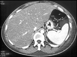 Cirrhosis - CTisus CT Scan