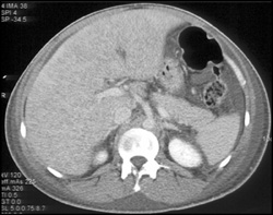 Cirrhosis With Liver Congestion - CTisus CT Scan