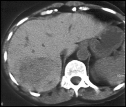 Hemachromatosis With Hepatoma - CTisus CT Scan