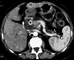 Metastatic Islet Cell Tumor With Stent in Distal Common Bile Duct (CBD) - CTisus CT Scan