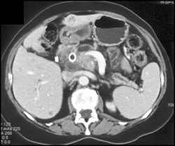 Metastatic Islet Cell Tumor - CTisus CT Scan