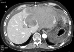 Spontaneous Bleed From Hepatic Adenoma - CTisus CT Scan