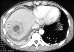 Liver Abscess - CTisus CT Scan