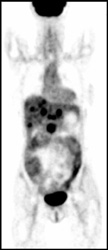 Metastatic Colonic Cancer - CTisus CT Scan