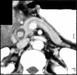 Impacted Stone in Distal Common Bile Duct (CBD) - CTisus CT Scan