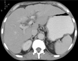 Dilated Common Bile Duct (CBD) and Cirrhosis - CTisus CT Scan