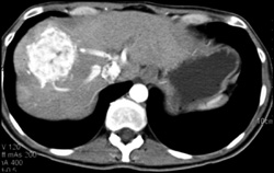 Metastatic Carcinoid Tumor - CTisus CT Scan