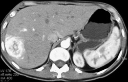 Metastatic Carcinoid Tumor - CTisus CT Scan