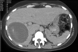 Hydatid Cyst - CTisus CT Scan