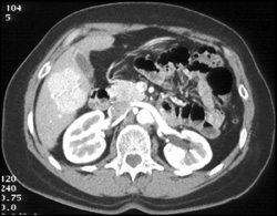 Focal Nodular Hyperplasia (FNH) - CTisus CT Scan