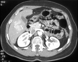 Focal Nodular Hyperplasia (FNH) - CTisus CT Scan