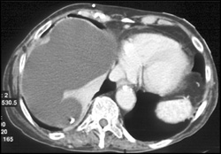 Subcapsular Collection Which Was CSF Due to Misplaced Shunt - CTisus CT Scan