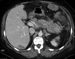 Pancreatic Cancer - CTisus CT Scan