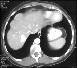 Focal Nodular Hyperplasia (FNH) - CTisus CT Scan