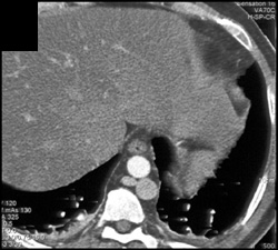 Fatty Liver - CTisus CT Scan