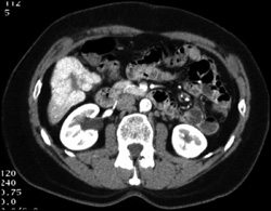 Focal Nodular Hyperplasia (FNH) - CTisus CT Scan