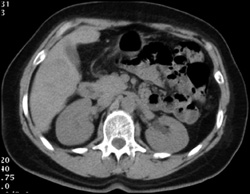 Focal Nodular Hyperplasia (FNH) - CTisus CT Scan