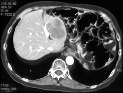 Hepatoma - CTisus CT Scan