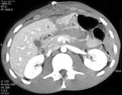 Liver Laceration With Bleed - CTisus CT Scan