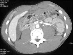 Liver Laceration - CTisus CT Scan