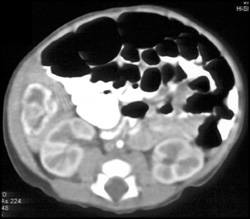 Hemangioma in Peds Patient - CTisus CT Scan