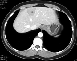 Focal Nodular Hyperplasia (FNH) - CTisus CT Scan