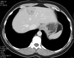 Focal Nodular Hyperplasia (FNH) - CTisus CT Scan