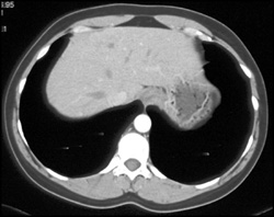 Focal Nodular Hyperplasia (FNH) - CTisus CT Scan