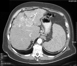 Occlusion of Portal Vein - CTisus CT Scan