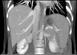 Normal Variant Hepatic Veins Empty Into IVC - CTisus CT Scan