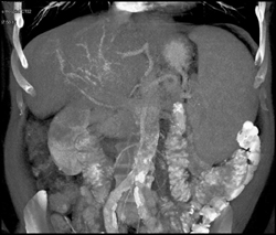 Hepatoma With Neovascularity - CTisus CT Scan