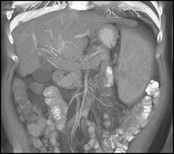 Hepatoma With Neovascularity - CTisus CT Scan