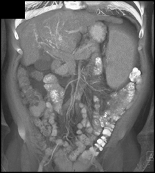 Portal Vein Thrombosis and Hepatocellular Carcinoma (HCC) - CTisus CT Scan