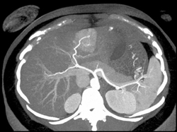 Focal Nodular Hyperplasia (FNH) With Feeding Vessel - CTisus CT Scan