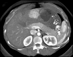 Focal Nodular Hyperplasia (FNH) - CTisus CT Scan