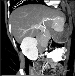 Focal Nodular Hyperplasia (FNH) - CTisus CT Scan