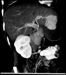 Focal Nodular Hyperplasia (FNH) - CTisus CT Scan