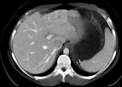 Focal Nodular Hyperplasia (FNH) - CTisus CT Scan