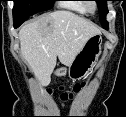 Unusual Hepatic Adenoma - CTisus CT Scan