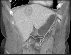 Hepatic Adenoma - CTisus CT Scan