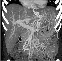 Cirrhosis With Varices - CTisus CT Scan