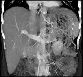 Cirrhosis With Varices - CTisus CT Scan