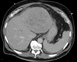 Hepatoma - CTisus CT Scan