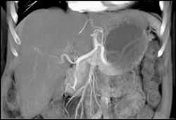 Hepatoma - CTisus CT Scan