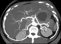 Hepatoma - CTisus CT Scan